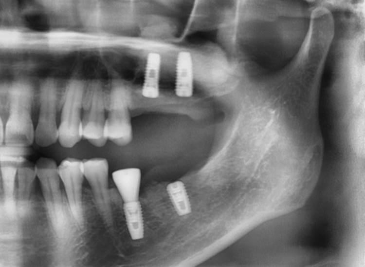 . Panoramic radiograph after implant placement in the maxilla.(3 weeks after implant placement in the mandible)