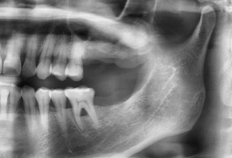 Panoramic radiograph before the implant surgery in the lower left area.
