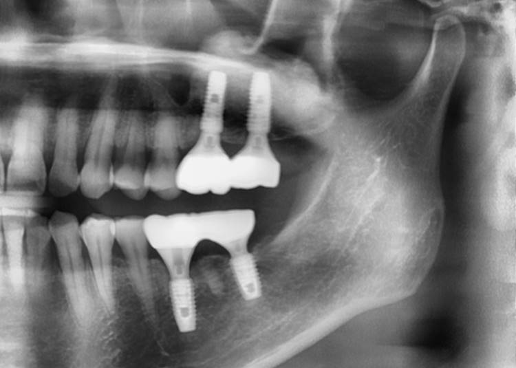 Panoramic radiograph after 1 year of the crown delivery.