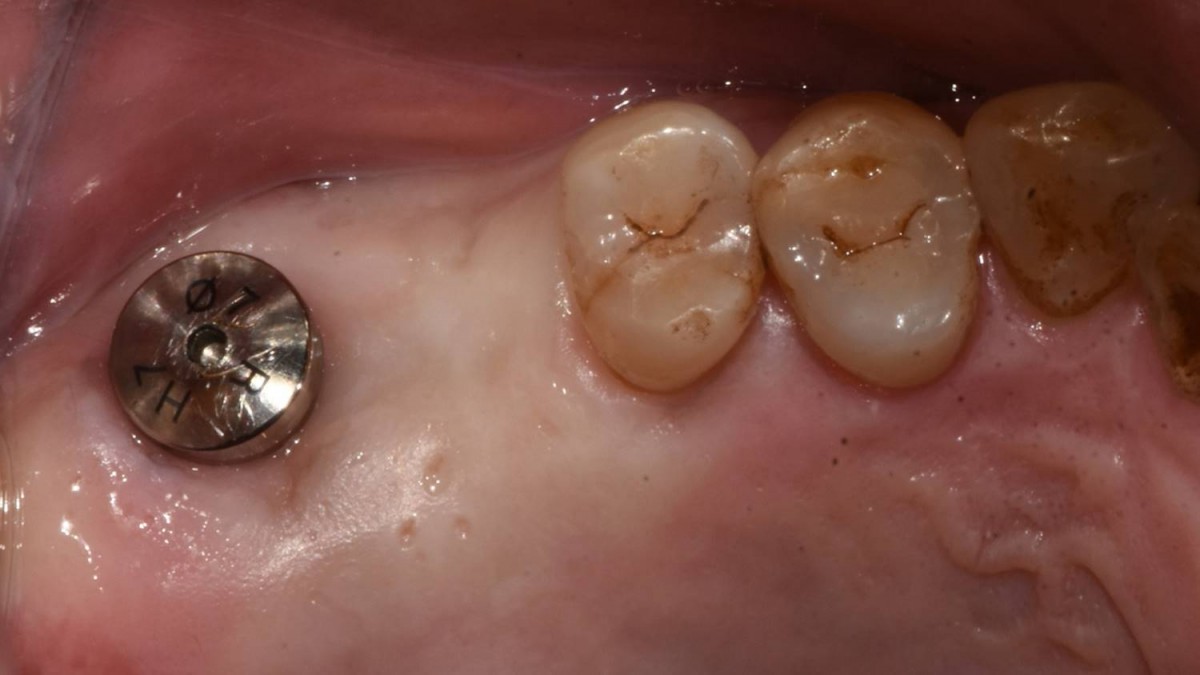 4 months after implant placement.  Intraoral view on the day of implant uncovery(2nd surgery).