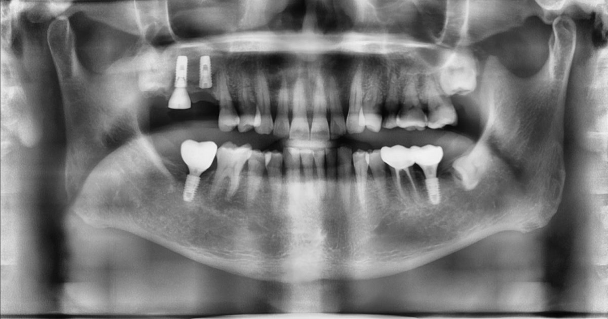 A panoramic radiograph after 2 implants were placed in the right maxilla.