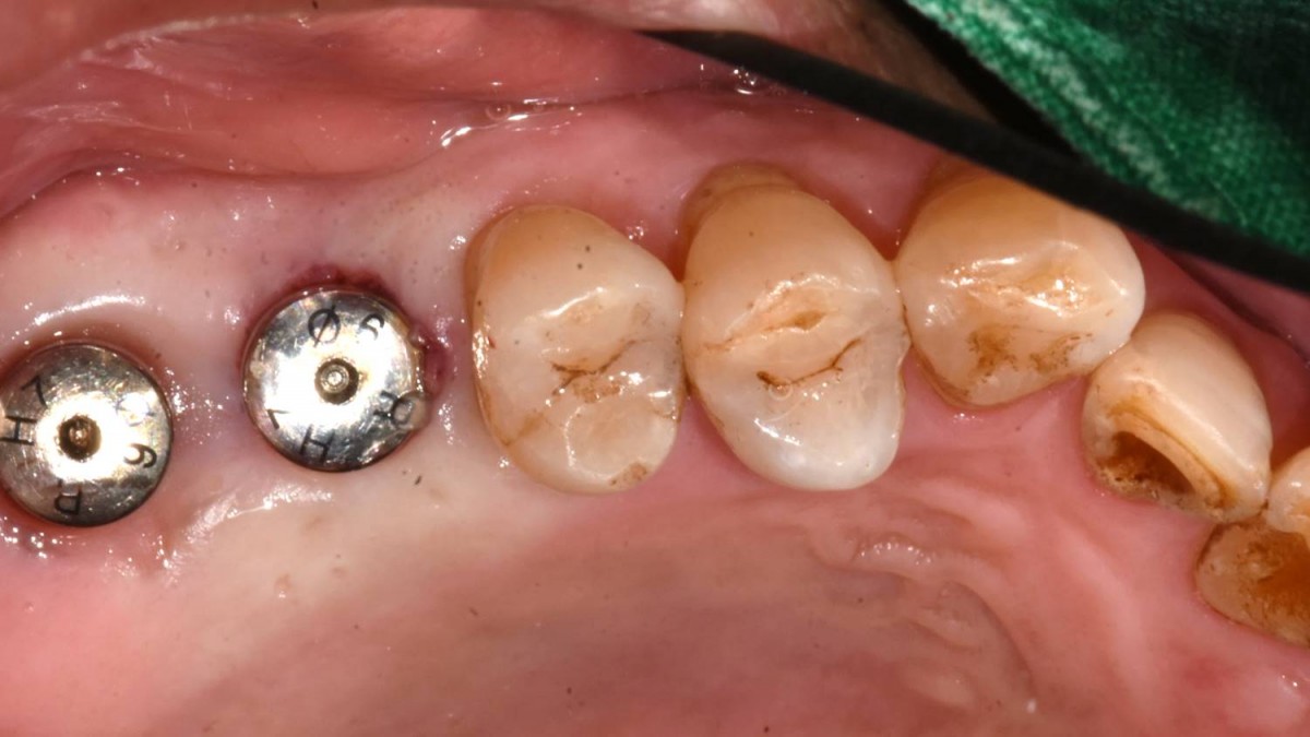 After the ISQ reading, the healing abutment was engaged to the fixture.