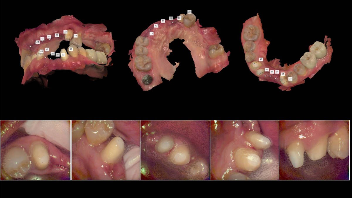 On the day of stitch removal (2weeks after implant surgery), intraoral scanning was performed to fabricate a temporary restoration