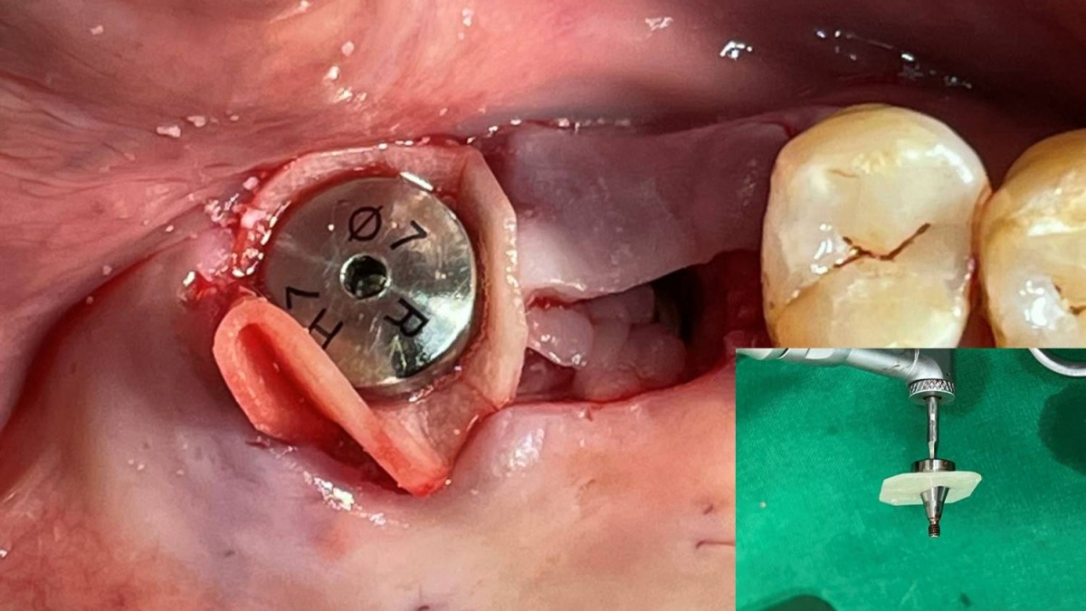 A membrane-engaged healing abutment was re-screwed into the fixture after unscrewing it.