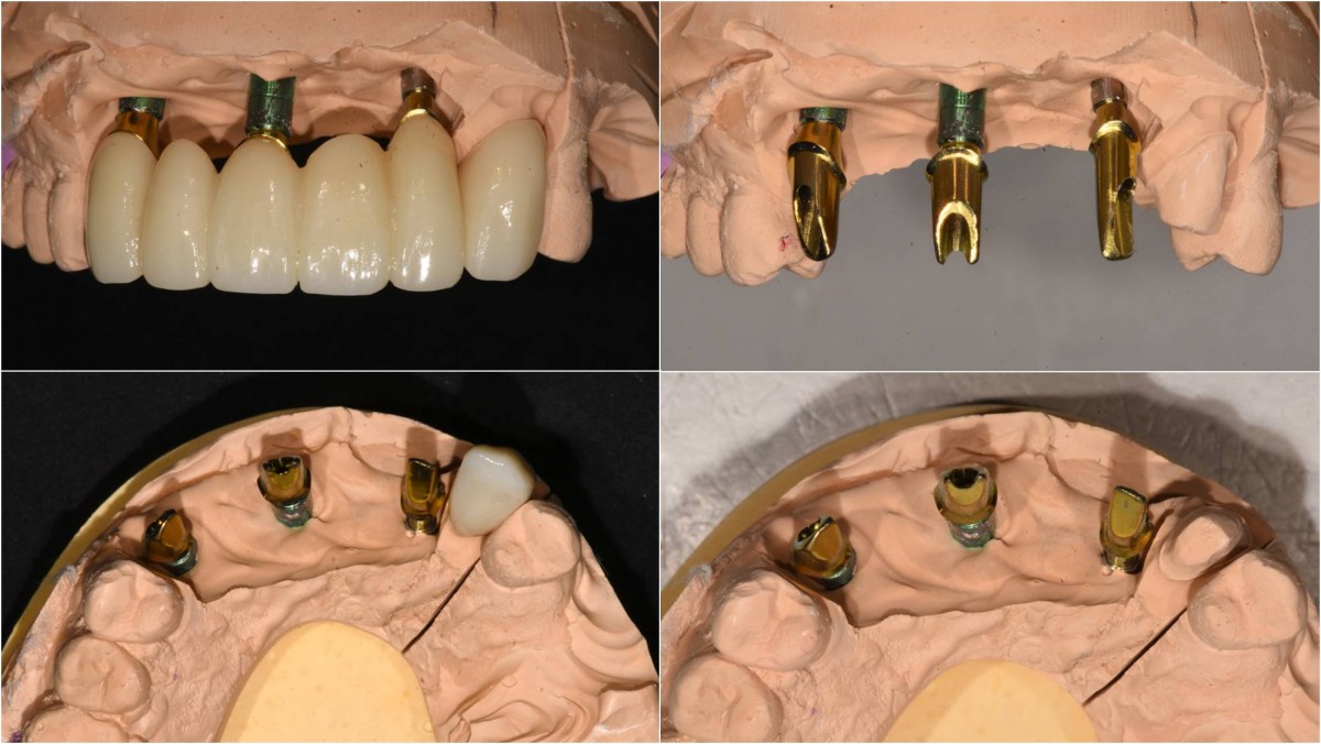 Custom abutment and zirconia Br, and single crown.
