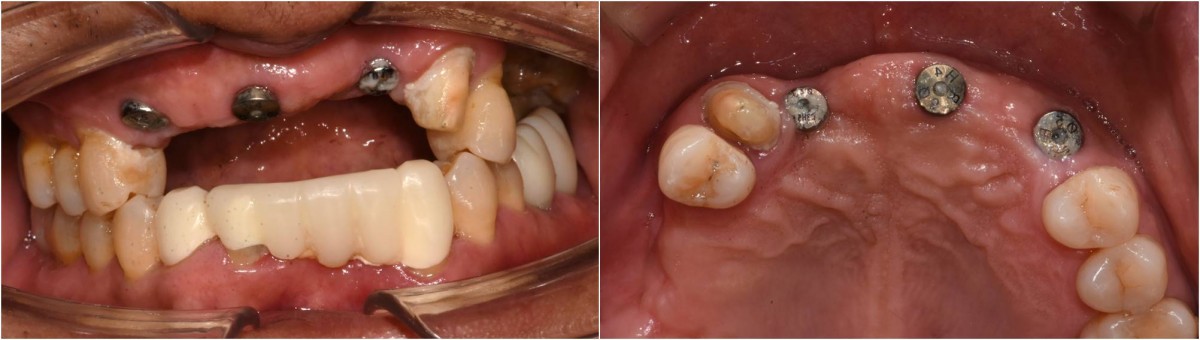 Intraoral photo in the day of impression taking , 6 months after implant placement.
