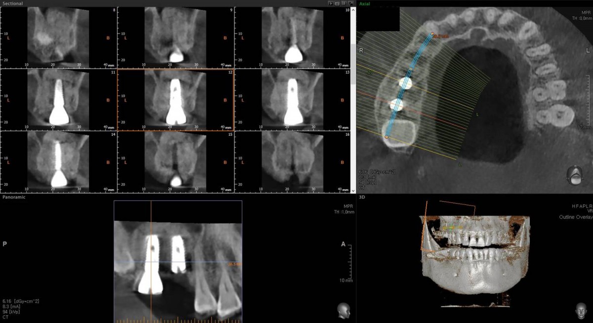 CBCT scan image focused on the 2nd molar zone.