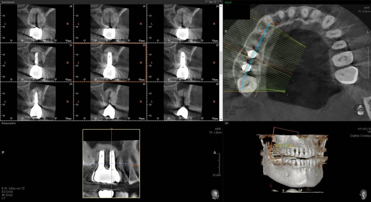 CBCT scan focused on 1st molar area after crown cementation