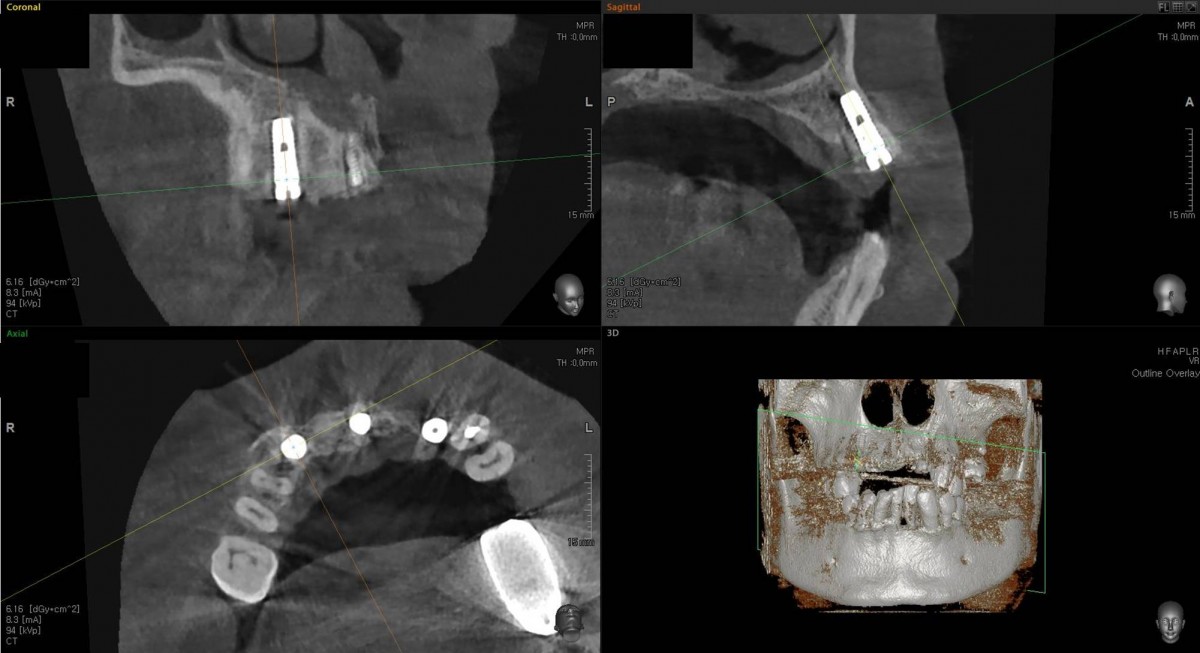 CBCT - canine zone