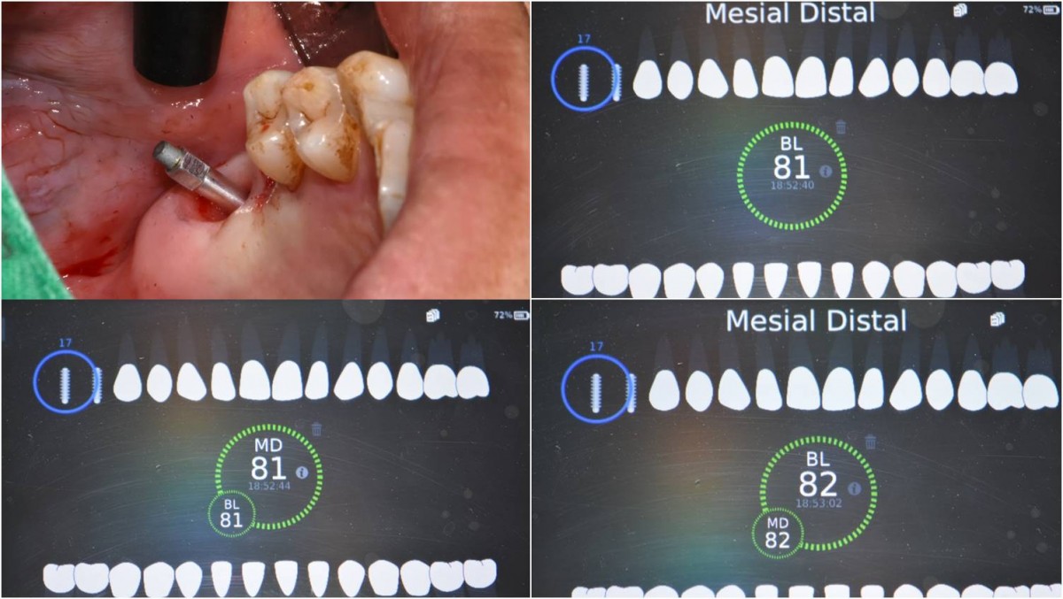 ISQ values at the 2nd molar area.