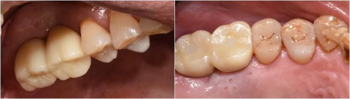  Intra-oral view after delivery (permanent cementation and access hole filling with composite resin).
