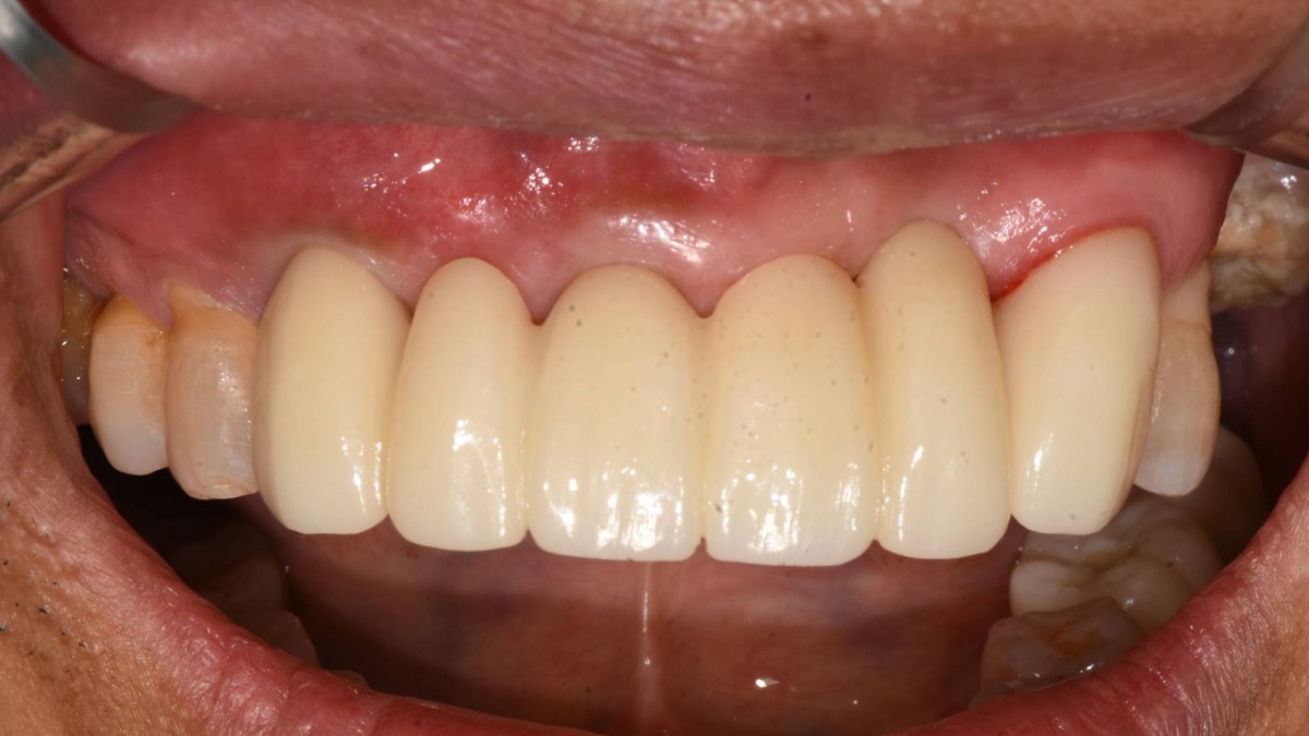 Implant-supported fixed partial denture and  single zirconia crown (lsft canine)
