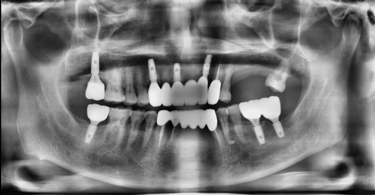 Panoramic radiograph after upper and lower prostnesis icementation.