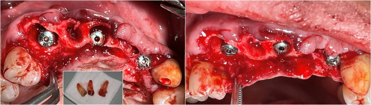 After teeth extraction, implants were placed.  Depending on the state of the implant, the condition of the surrounding alveolar bone, and the degree of initial fixation, HA was connected to the canine and lateral incisor, and the cover-screw was connected to the implant in the central incisor.
