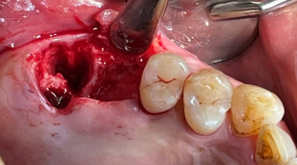 The 2nd molar extraction 