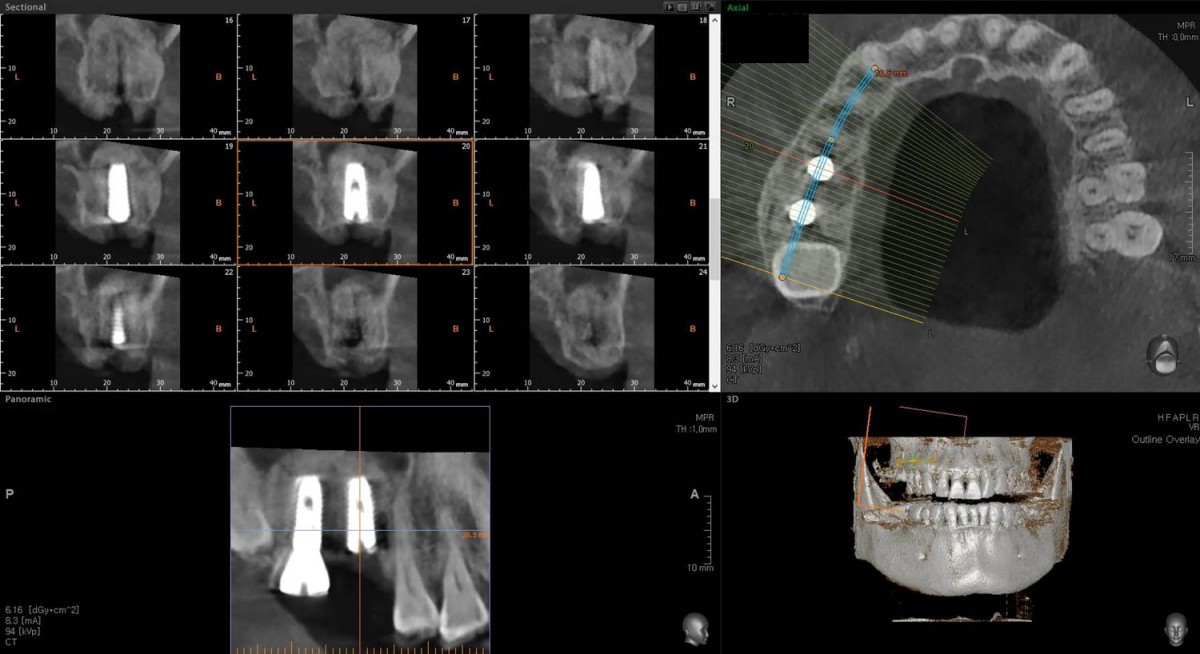 CBCT scan image focused on the 1st molar zone.