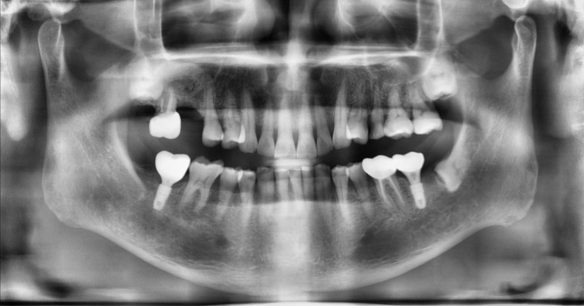 Radiograph was taken right after maxillary sinus graft