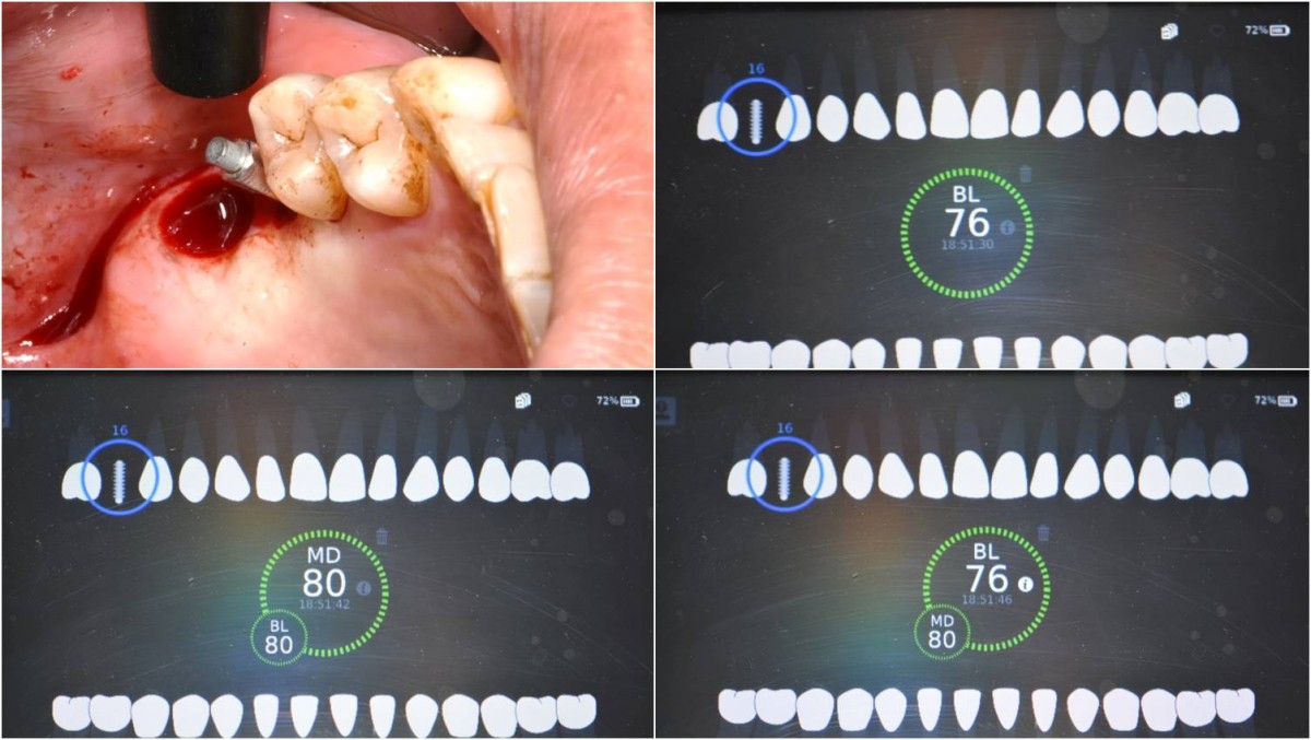 4 months after implant placement.  Implant uncovery and ISQ reading was performed.  ISQ values at the 1st molar area.