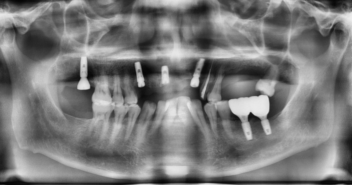 Panoramic radiograph after implant placement.