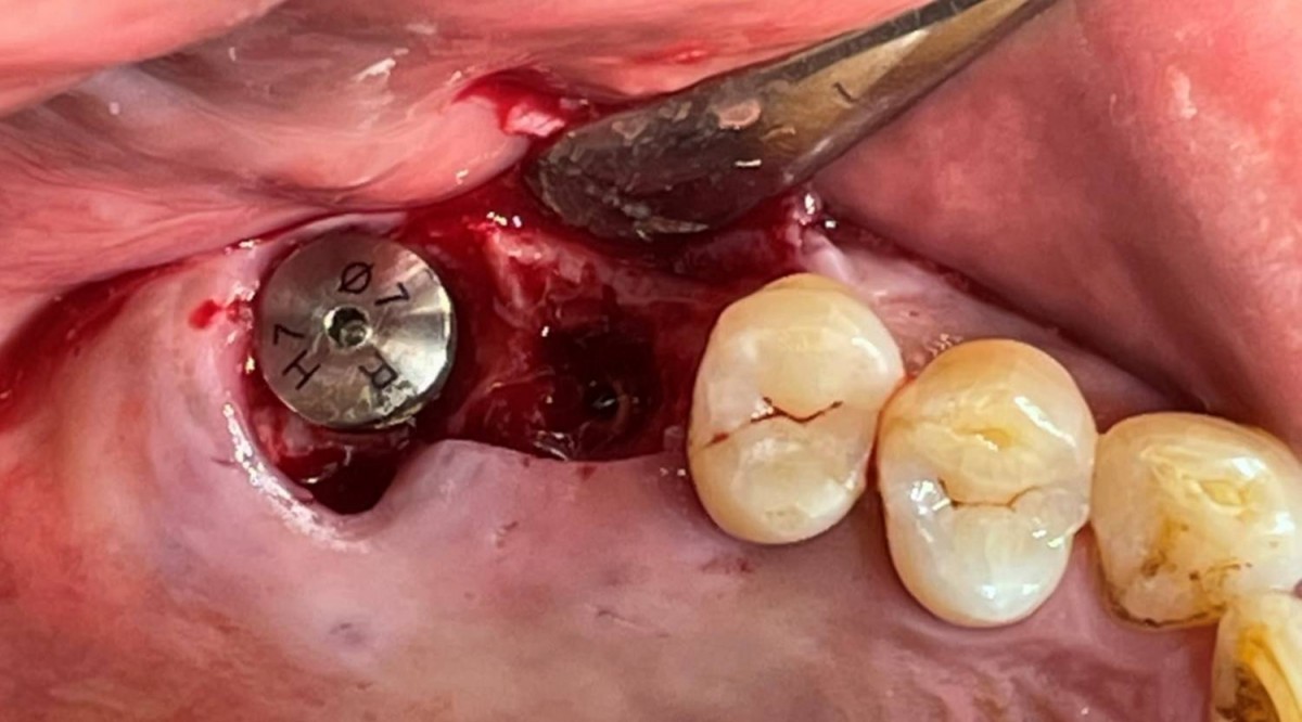 A healing abutment was connected to the immediately placed implant