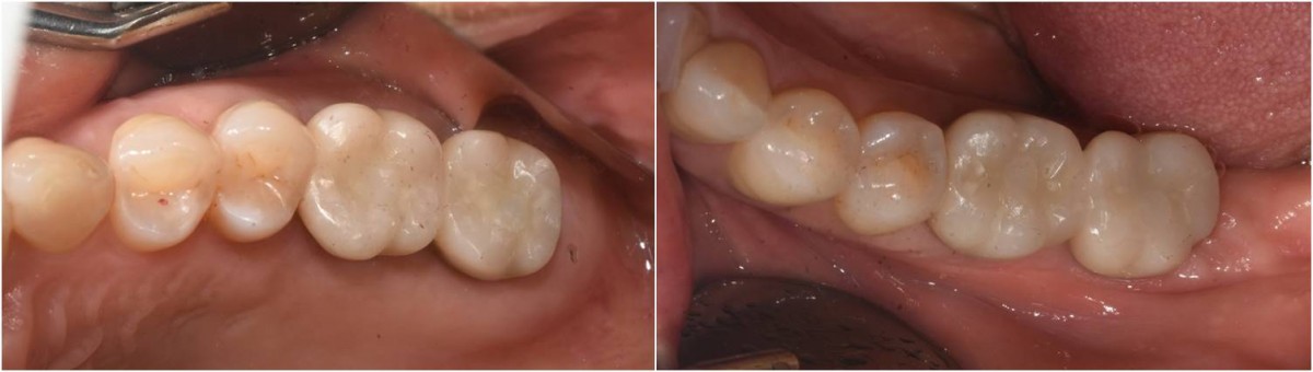  Intraoral photo after cementation.