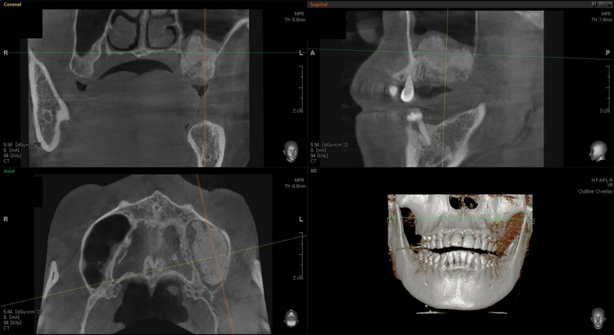 A maxillary sinus graft was performed 3 months ago.
