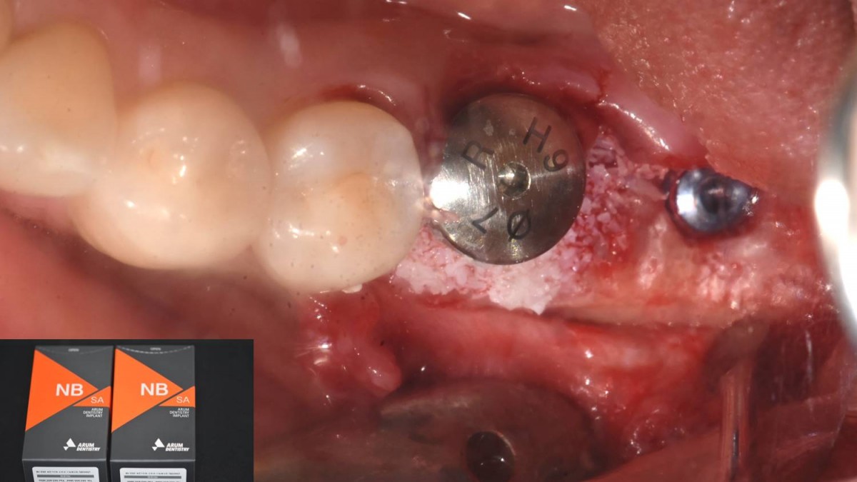 Immediate implant placement, healing abutment engagement. Arum Dentistry NB1 5*10 (30Ncm).