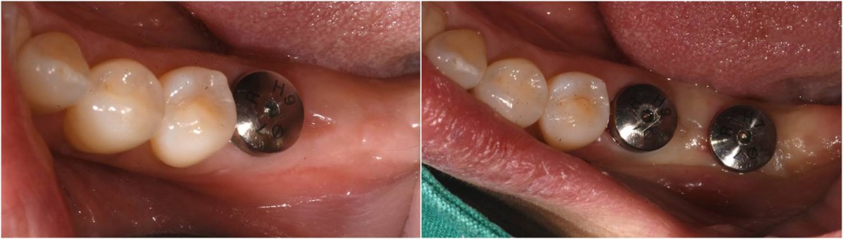 Healing abutment engagement at the second molar zone. (3 months post-op.)