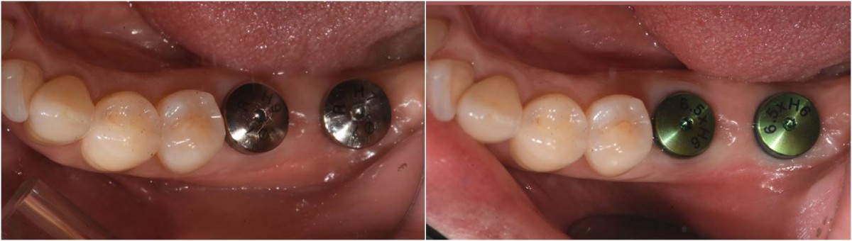 To create a gingival shape of an appropriate size, HA of a different size(diameter and height) from the existing one was applied.