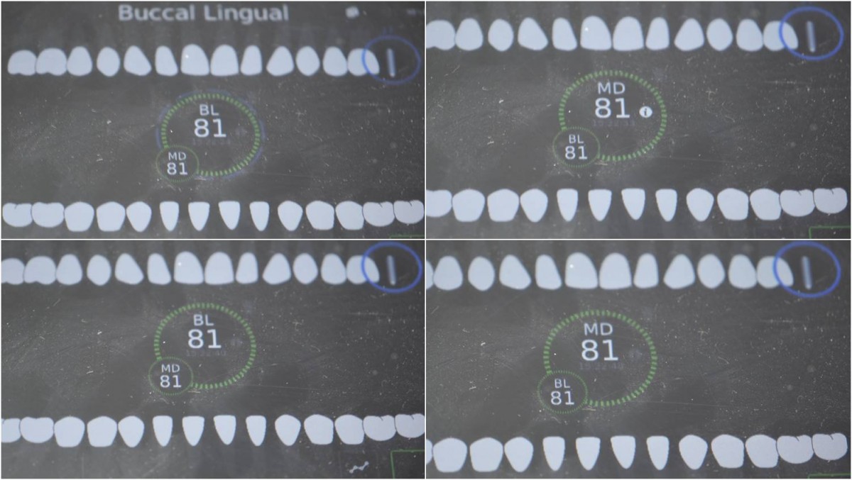 ISQ reading at the second molar zone of the maxilla