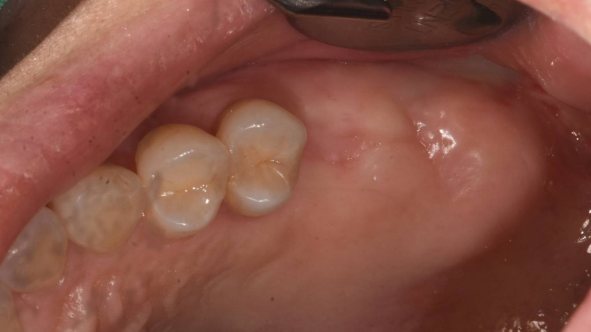 Upper jaw. Intraoral photo before implant surgery.