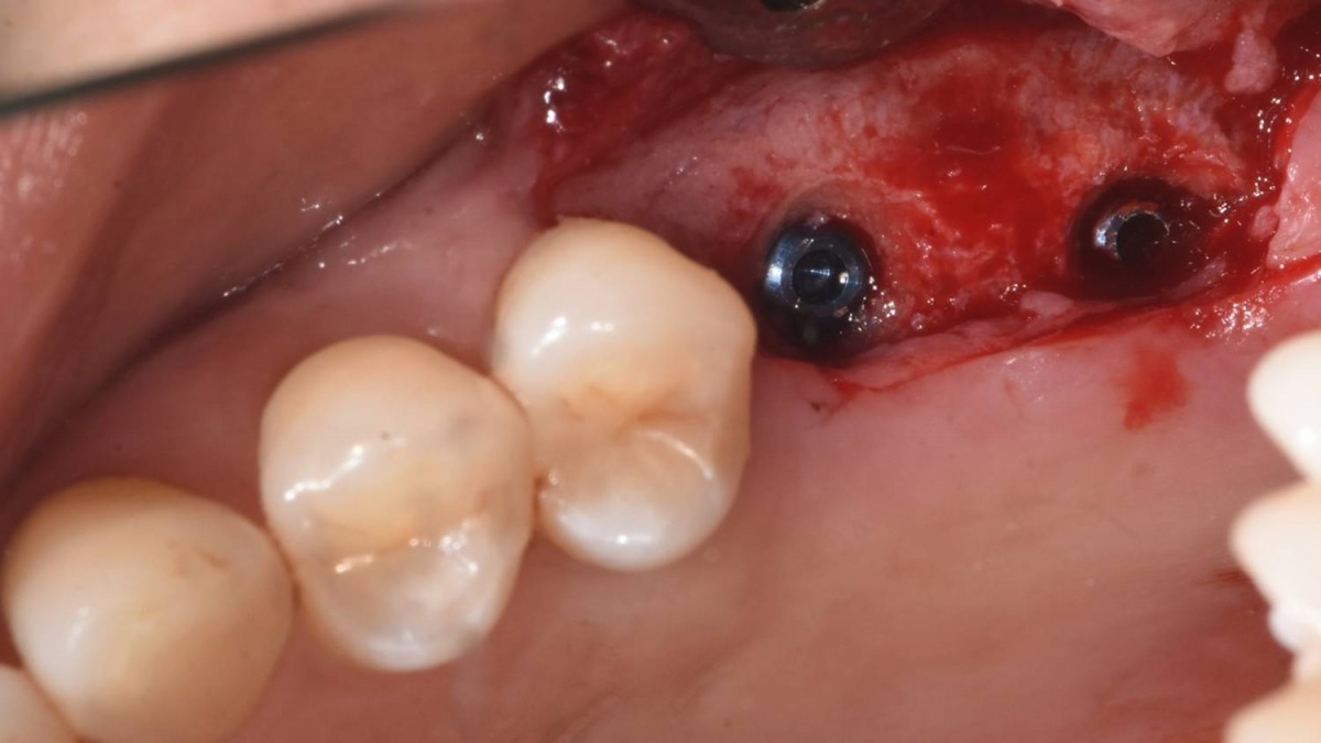 Arum Dentistry NB1 5*11.5 (first molar-30Ncm, second molar-15Ncm).