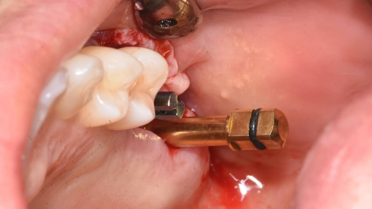 Check the orientation of the two implants using the direction pin.