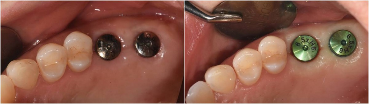 To create a gingival shape of an appropriate size, HA of a different size from the existing one was applied.