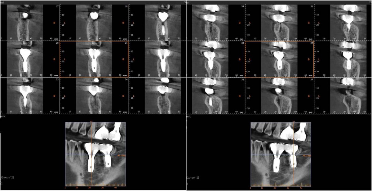 CBCT. 1 year after crown delivery.