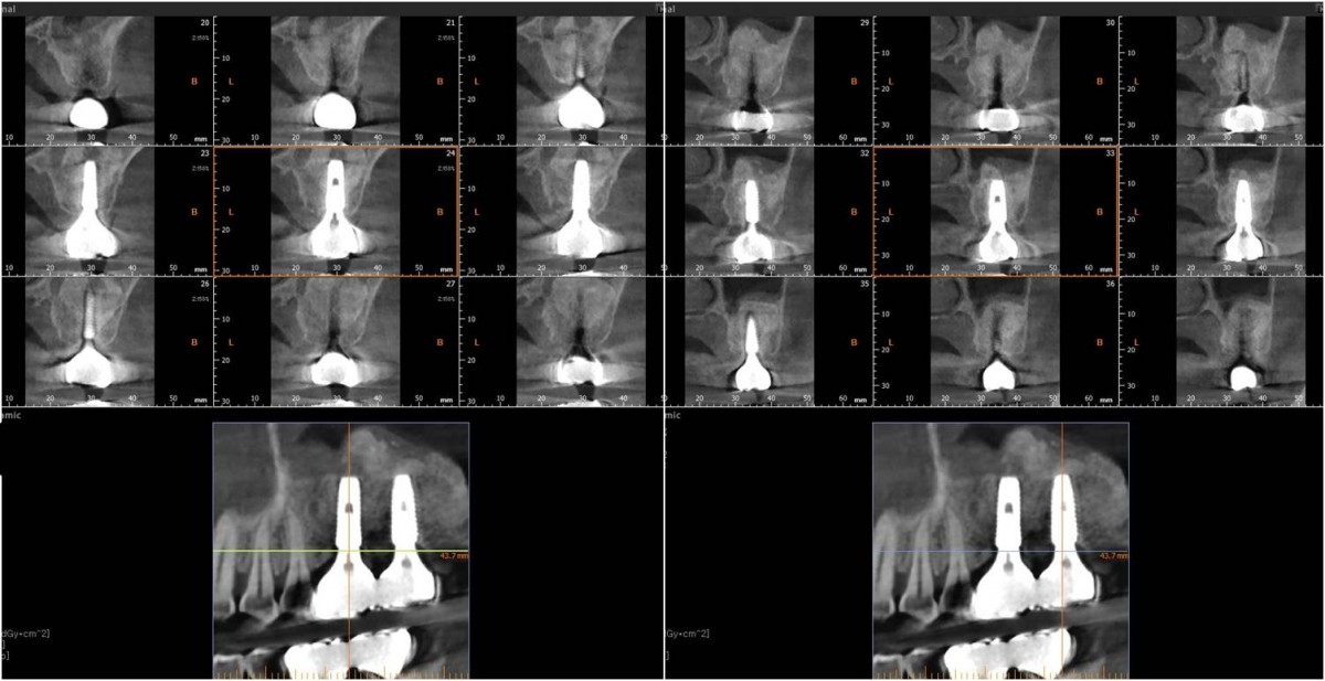 CBCT. 1 year after crown delivery.