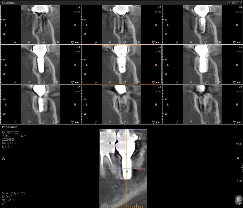 CBCT view. 8 years after occlusal loading.
