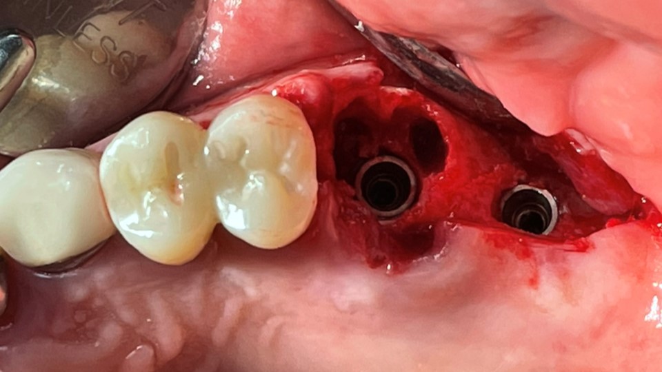 2 implants were placed.  ArumDentistry NB1 5*10 (30Ncm) in the 1st molar and 5*10 (10Ncm) in the 2nd molar.