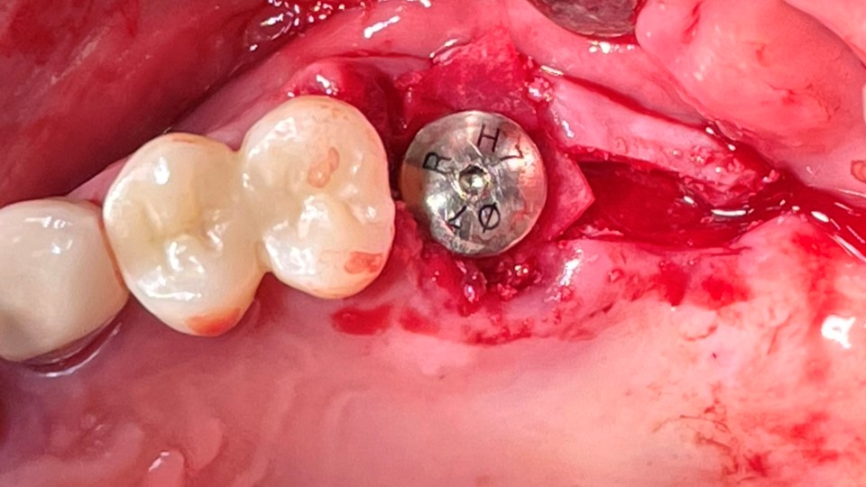 HA was inserted into the membrane with a hole in the middle and then inserted into the place where the Direction Pin was pulled out