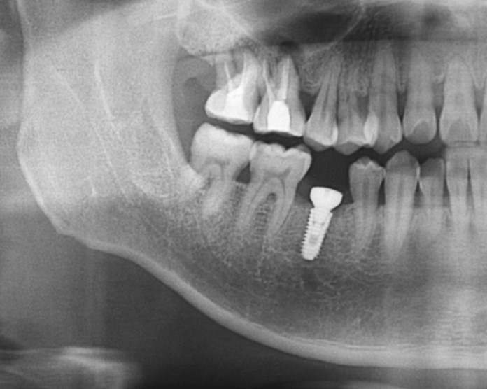 Radiograph after impant surgery.