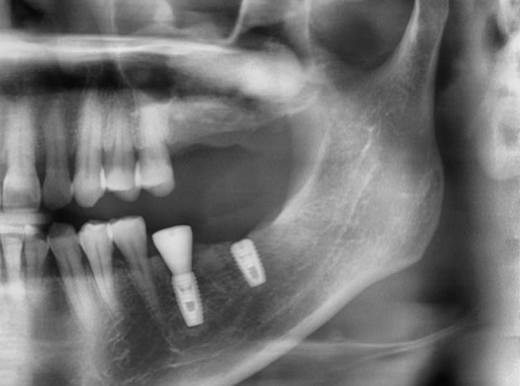 post-op panoramic radiograph. 