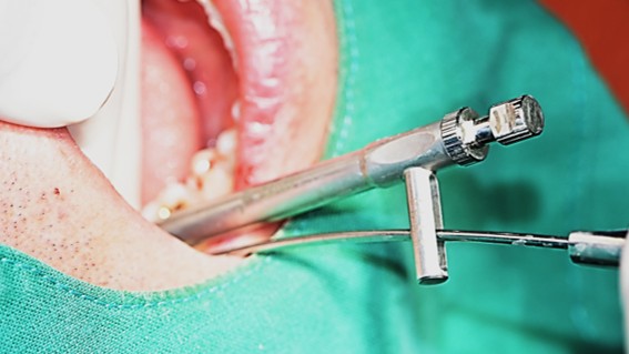 torque value after insertion