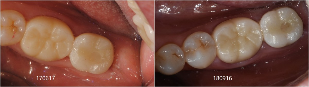 a couple of month later and a year later