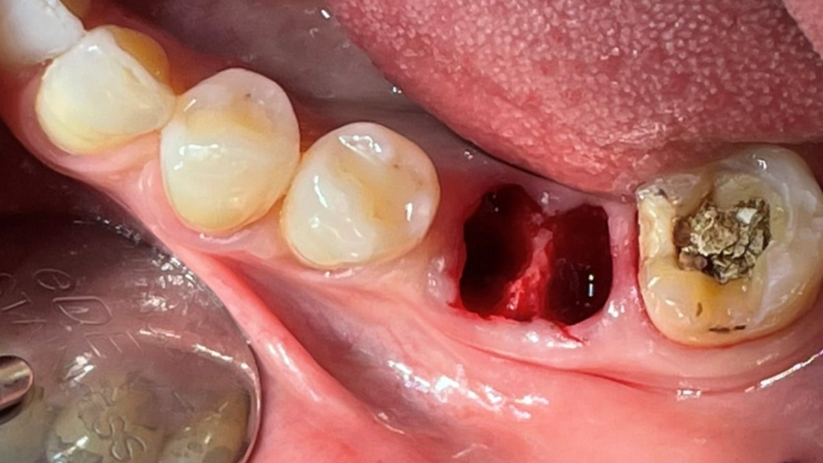 serial drilling was performed in the socket of the mesial root.
