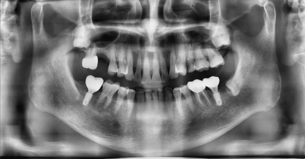 Pre-op panoramic radiograph.