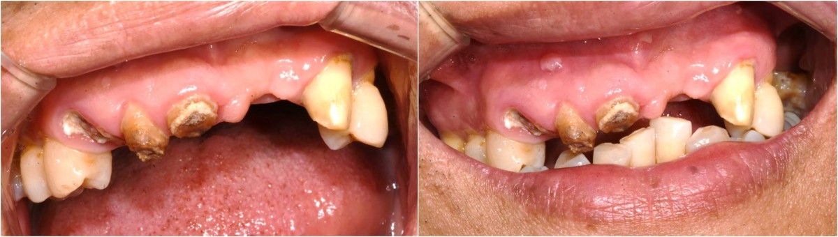 It was checked that the relationship between upper and lower anterior teeth when occluded.  For normal shape and occlusion, treatment of not only the maxillary anterior teeth but also the mandibular anterior teeth seems to be necessary.