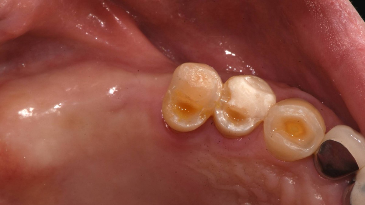 4.5months post-op. Intra-oral photo on the day of implant uncovery(2nd surgery).