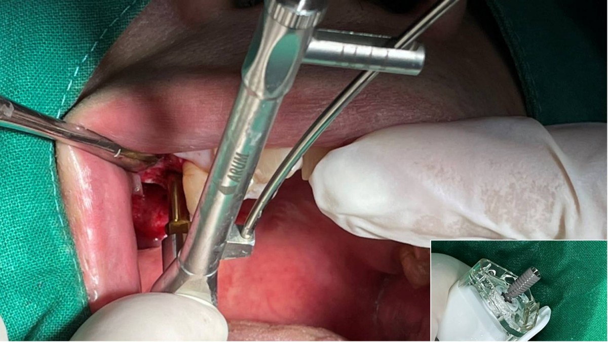 Insertion torque was 35Ncm at the 1st molar zone. Arum NB1, 5*10