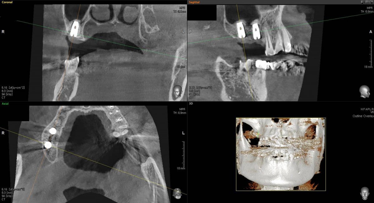 CBCT scan image focused on 2nd  molar zone,