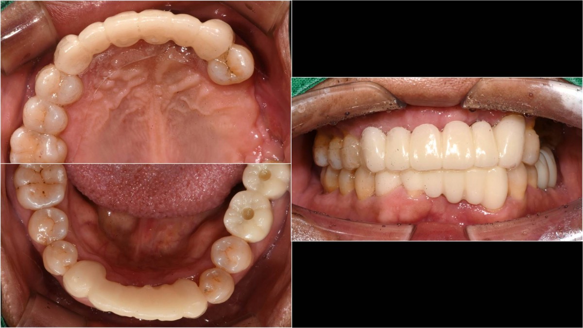 3 weeks after implant surgery. The provisional restoration was delivered.